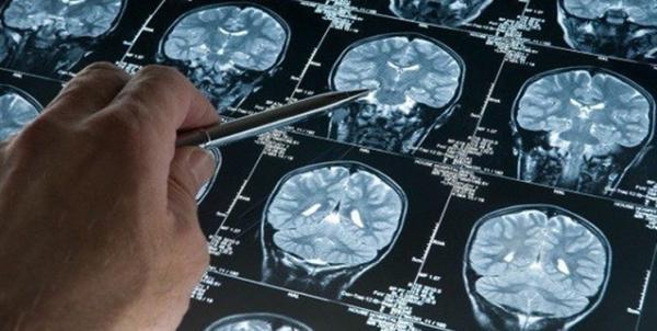 سکته مغزی در کرونایی ها احتمال مرگ را 3 برابر بیشتر می کند