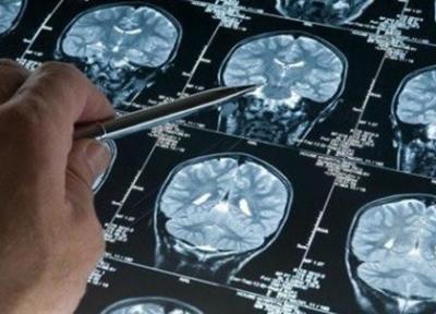 سکته مغزی در کرونایی ها احتمال مرگ را 3 برابر بیشتر می کند